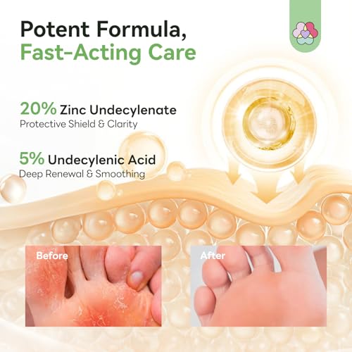 Image of SAVILAND Antifungal Cream 120g Extra Strength: Max 25% Undecylenic Acid Fungal Cream for Skin Athletes Foot Jock Itch Ringworm Foot Fungus Treatment Natural Skin Relief with Tea Tree & Oregano Oil