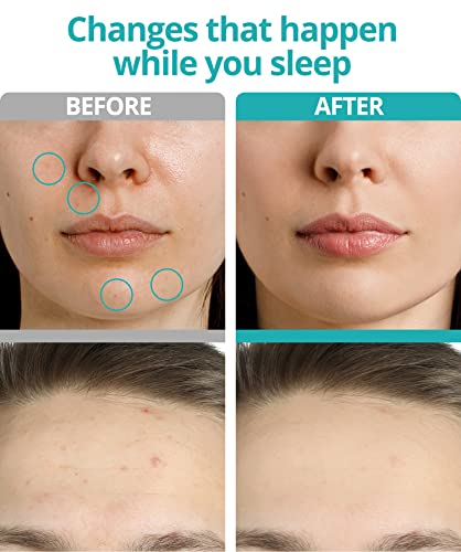 VILVIN Patch de dissolução Microdart para acne para manchas profundas - 9 adesivos - Removedor de ma