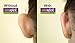 Otostick Cosmetic Ear Correctors