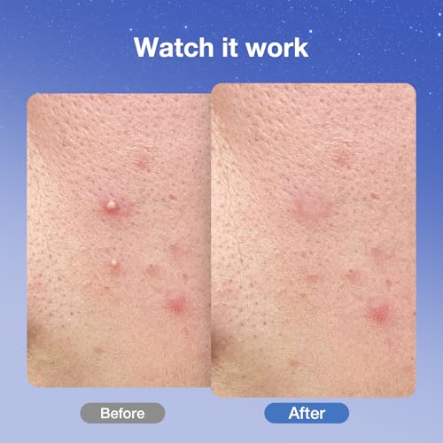 arvyne Overnight Pimple Patches 1.5X Thicker Hydrocolloid Acne Zit Patches for Face, All-Night Adhesion, Max Absorbency, Easy-Peel Design, Skin-Friendly, Korean Skin Care, 2 Size 36 Count β image 4