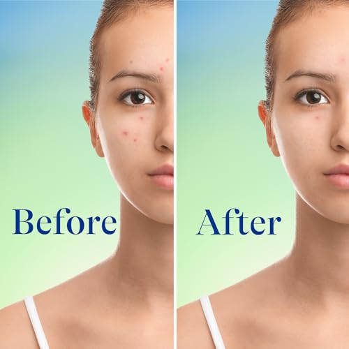 Differin 0299.413700 Acne Face Wash With 10% Benzoyl Peroxide, Maximum Strength Otc Acne Foaming Cleanser, Fast Acting Acne Treatment For Face And Body thumb #5