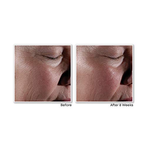 Roc Retinol Correxion Max Wrinkle Anti-Aging Skin Care System, Hyaluronic Acid Anti Wrinkle Treatment And Skin Radiance Resurfacing Serum For Fine Lines, Dark Spots, Acne Scars, Set Of 2 #TOP4