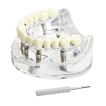 Dental Model Overdenture Transparent Upper Jaw with 6 Implants Dental Implants Model Detachable Model Dental Teaching Model Suitable for Education and Study