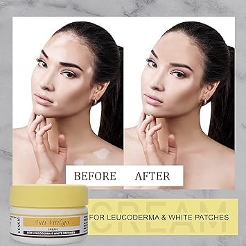 Miniatura 3 de Crema antivitíligo  Súper eficaz en vitíligo, parches blancos, decoloración de la piel, eliminación de cicatrices  80gm