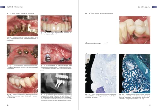 Infezione Perimplantare: Eziologia, Diagnosi E Trattamento - 10