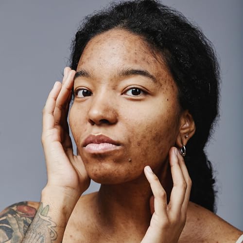 Ep 02: El Acn&eacute; con Palitos y Bolitas