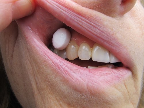 XyliMelts for Dry Mouth, Mint-Free, 80-Count Box