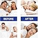Noctivo Mouth Tape For Sleep Apnea, Noctivo Mouth Tape, Noctivio Mouth Tape For Sleeping Snoring, Mouth Breathing Tape, Breathing Noctivio Mouth Tape for Sleep Apnea, Comfort & Easy Breath (1Pcs)