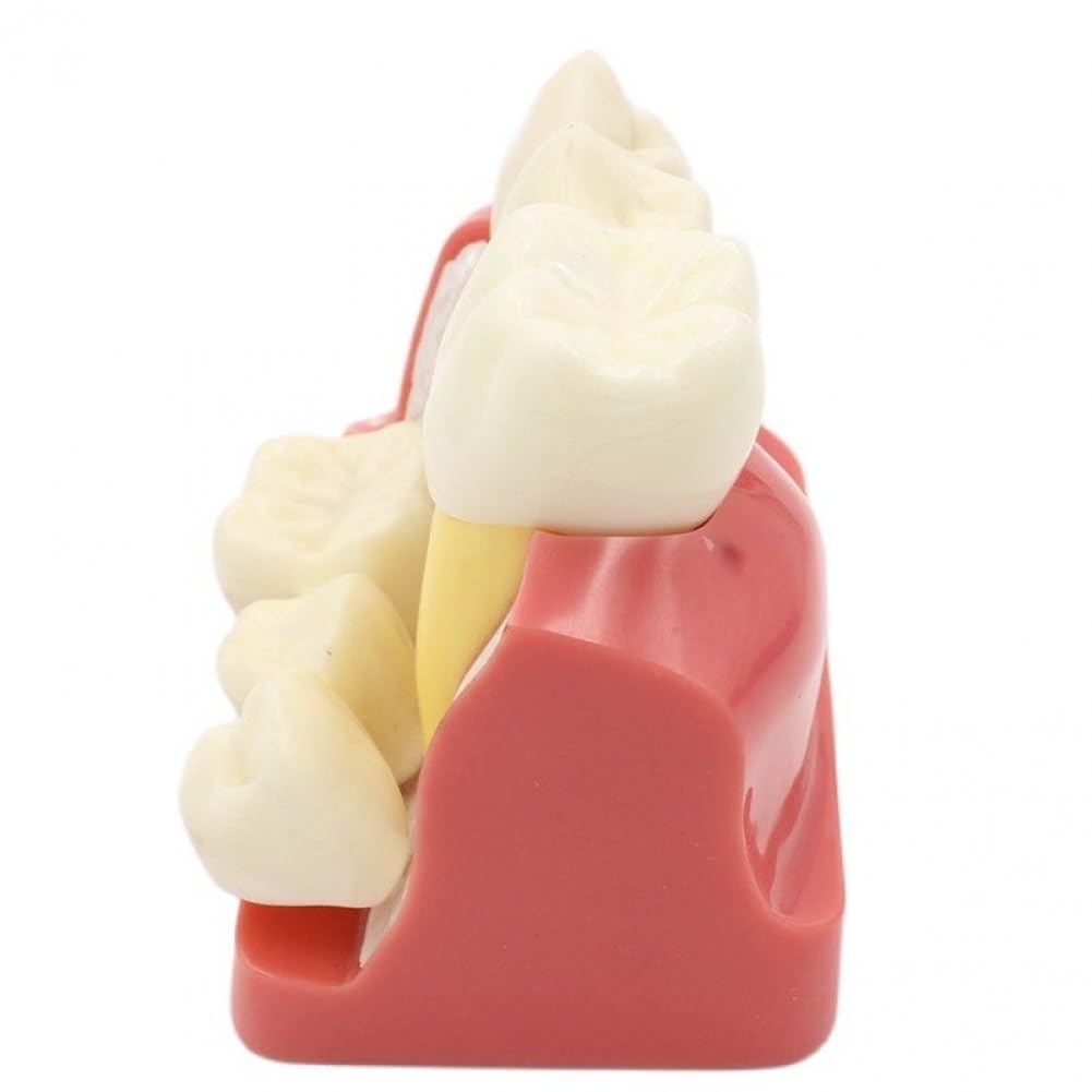 Modello di Impianto Dentale 4 Volte Modello di Denti Dimostrativo Ingrandito Modello di Denti Didattici Modello di Analisi Rimovibile Ponte della per Studente di Odontoiatria
