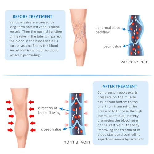 20-30mmhg compression pantyhose for women medical compression stockings high waist opaque compression tights for lymphadema edema swelling varicose veins support hose for teacher doctor