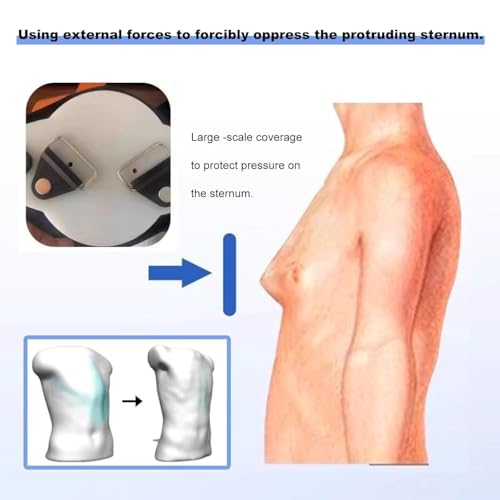 Pectus Carinatum Orthosis Brace - Fijación torácica ajustable para todas las edades - Correctores de costillas valgus