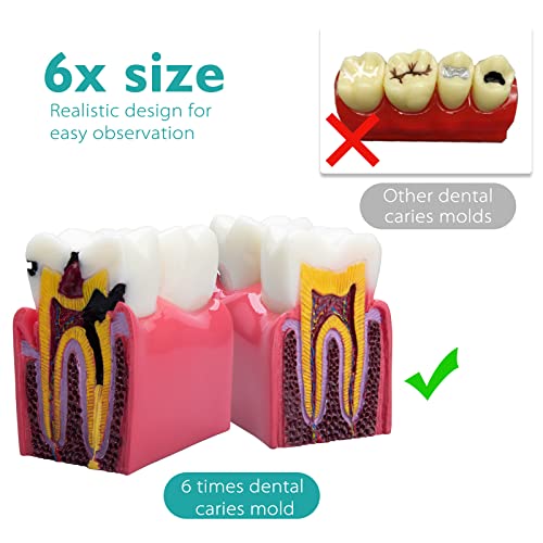 Lvchen Dental Caries Teeth Model - Anatomy Education Model Caries Bilateral Comparison Study Model 6 Times Cross-Section Demonstration Model Tooth Decay Props For Science Teaching #TOP2