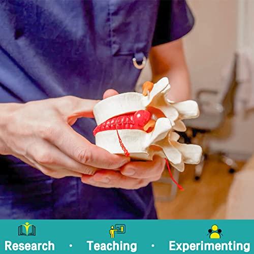 Image of Disc Herniation Model - Human Lumbar Disc Herniation Spine Model 1.5X Intervertebral Disc Model Anatomical Vertebrae Disc Model with Elastic Software