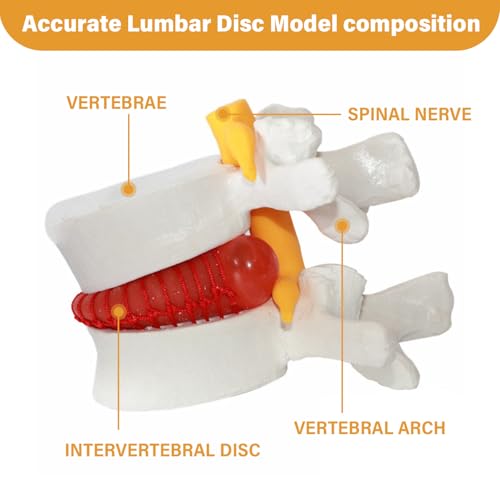 Modèle de hernie discale lombaire pour simplifier les cours d'anatomie complexes