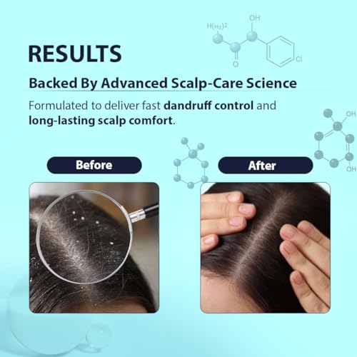Image of Dermistry Climbazole Piroctone ZPTO Anti-Dandruff Treatment Shampoo Reduces Dryness Flakes Itching Irritation Exfoliates Dry Oily Itchy Scalp Suits Dry Frizzy Curly All Hair Types for Men Women 200ml