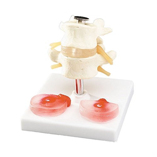 Lumbar Vertebrae with Interchangeable Discs