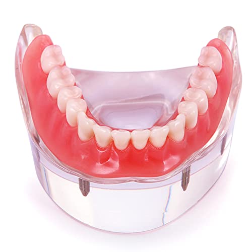 AZDNET Dental Implant Model Demo Overdenture Restoration with 4 Implants Lower Tooth Mandibular Teaching Study Teeth Model