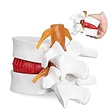 logiciel anatomie 3d gratuit Affichage grossissant 1,5 fois : le modèle de hernie discale de la colonne vertébrale adopte un grossissement 1,5 fois pour une observation facile