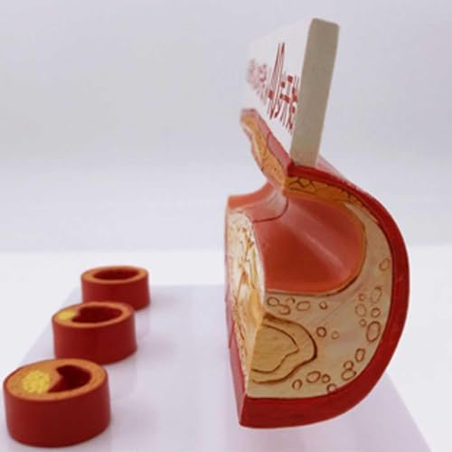 Modèle vasculaire de thrombose AMITD numéroté pour cours médicaux - 4