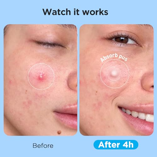 Glowpatch Pimple Patches (504 Count) — view 4