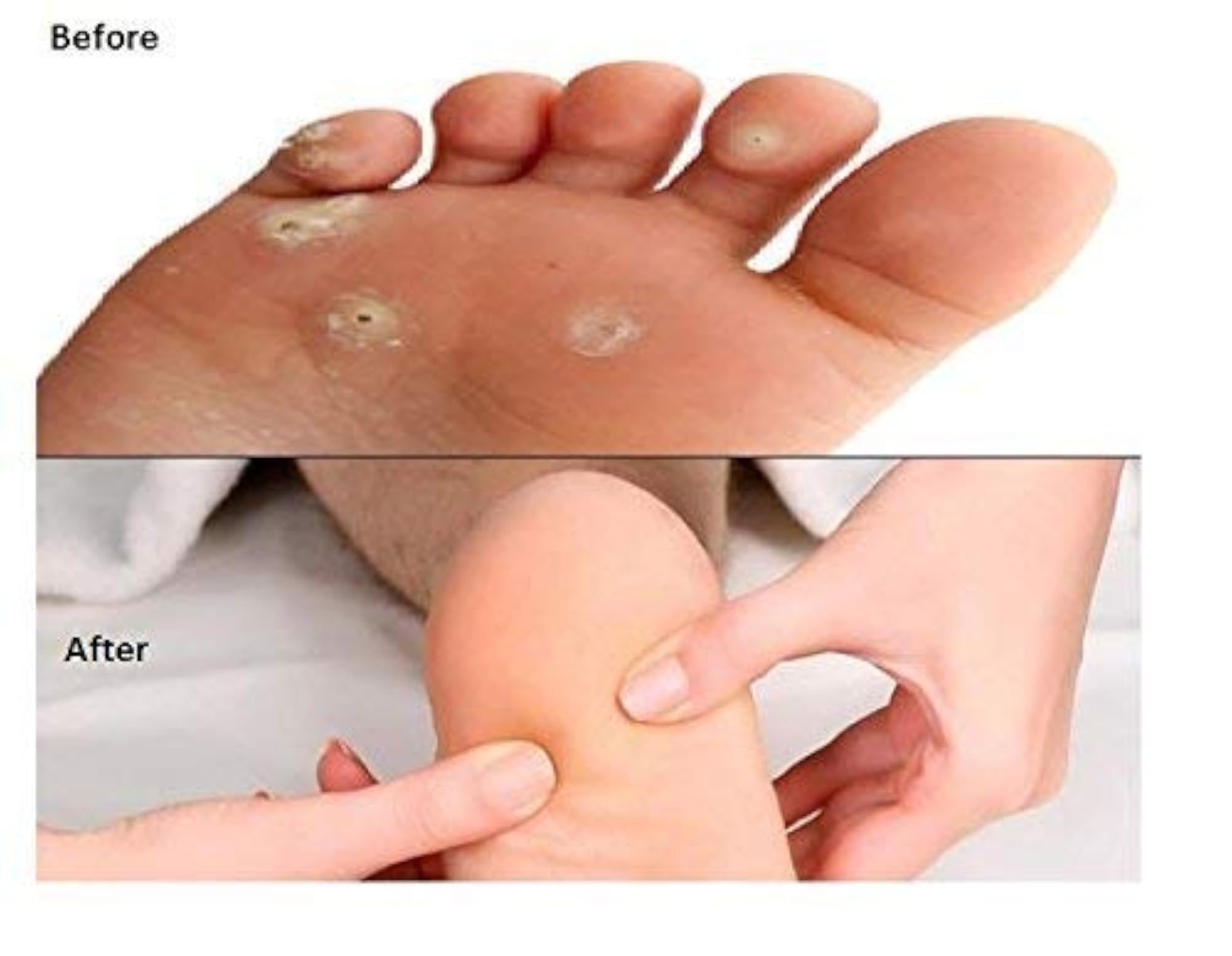 Foot Pedicure Corn Cutter with 25 Blades, Dead Skin Remover
