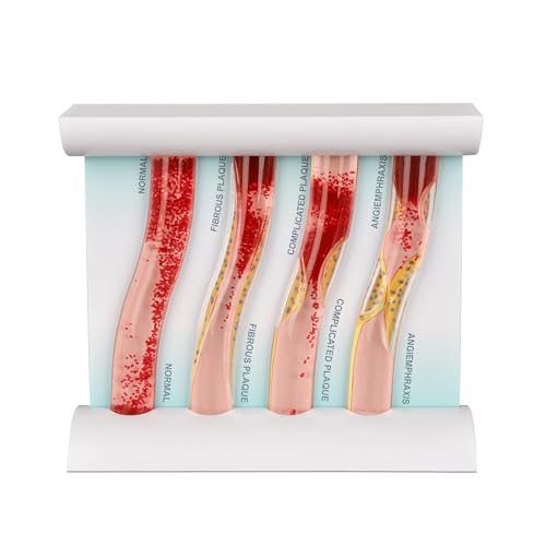 SimCoach Low-Density Lipoprotein LDL Blood Vessel Model for Medical Patient Doctor Teaching, Vascular Demonstration Training Tool, Four Stage Vascular Conditions