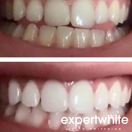 Image of 44% Teeth Whitening Gel - Refills for Trays - Professional Strength Carbamide Petoxide Syringes, 4 x 3cc, 15-Minute Treatment, Gels Only (No Trays)