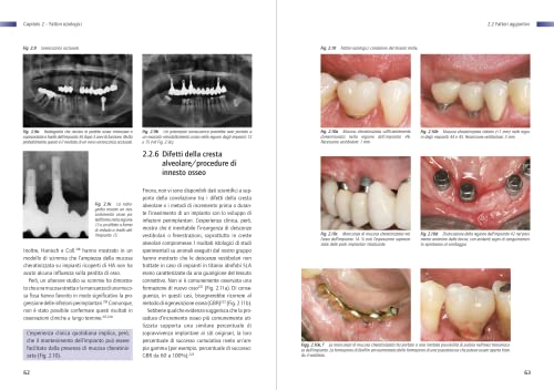 Infezione Perimplantare: Eziologia, Diagnosi E Trattamento - 9