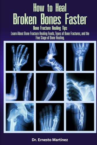 How to Heal Broken Bones Faster. Bone Fracture Healing Tips: Learn About Bone Fracture Healing...