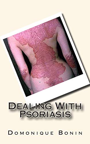 Dealing With Psoriasis