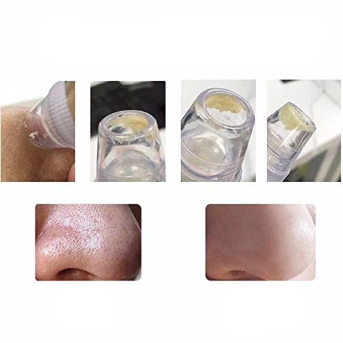 Removedor de Cravos e Espinhas Portátil à Vácuo - Pilhas Incluídas