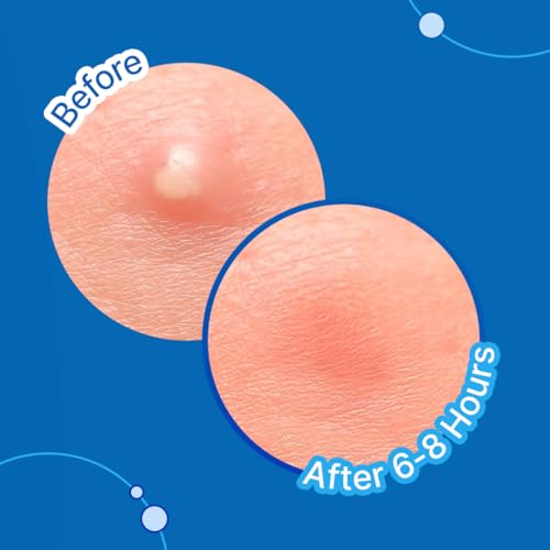 Image of Sotrue Acne Pimple Patches For Face | For Active Surface Acne | Hydrocolloid Waterproof Patches | Absorbs Pimple Overnight, Reduces Excess Oil | Suits All Skin Types (54 Patches)