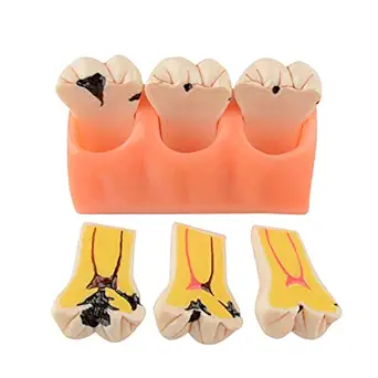 Ultrassist Dental Teeth Caries Model, 4 Times Dental Tooth Model