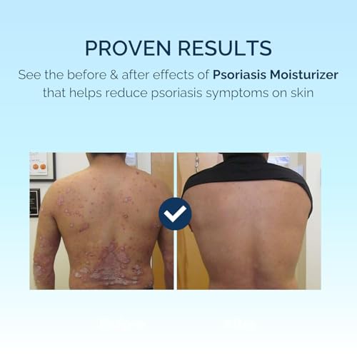 Image of Kengold Psoriasis Skin & Hair Soap+Cream+Oil | Purify Skins | Pain Relief With Natural Ingredients (Psoriasis Soap+Cream Combo)