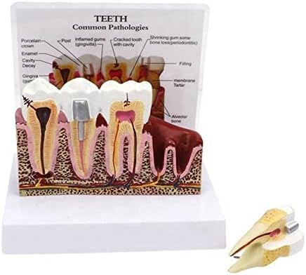 Model Zębów Próchnicy, Model Zębów Dentystycznych Do Badania Anatomii Zębów Dentystycznych, Edukacji Lekarza-pacjenta I Higieny Jamy Ustnej,Serene16