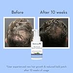 WishCare Hair Growth Serum Concentrate - Rosemary, 3% Redensyl, 4% Anagain, 2% Baicapil, Caffeine, Biotin, Plant Keratin & Rice Water - Image 3