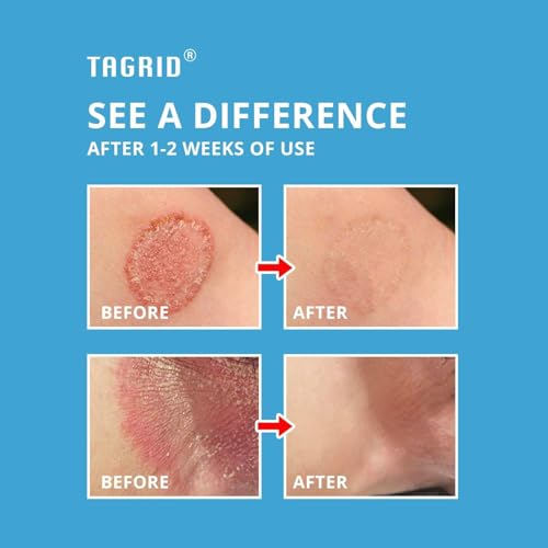 Image of TAGRID Jock Itch Relief Cream: Jock Itch Relief for Men and Women - Soothing & Fast-Absorbing Skin Cream for Irritation, Burning, & Discomfort - Non-Staining & Gentle for Sensitive Areas - 3.5 OZ