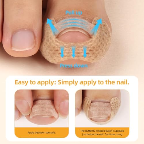 Image of 101 /190pcs Ingrown Toe Nail Remover, Toenail Corrector Strips and Ingrown Toenail Correction Tool, for Daily Nail Care and Post-Exercise Maintenance (190PCS Brown)
