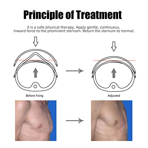 Shuyan Jiao Pectus Carinatum Orthosis Brace, Pigeon Chest Orthosis