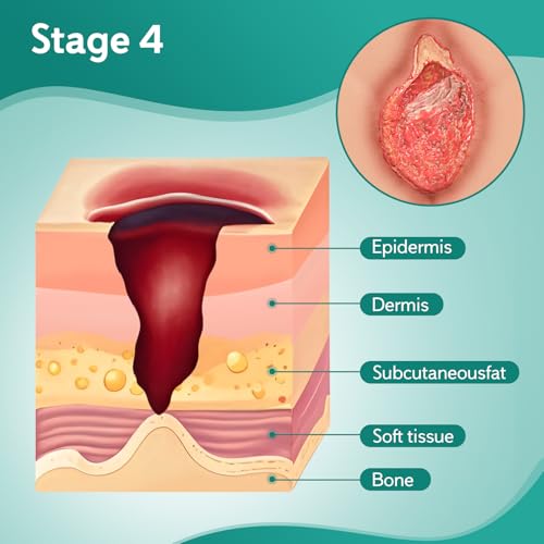 Image of Decubitus Ulcer Care Model, Bedsores Model