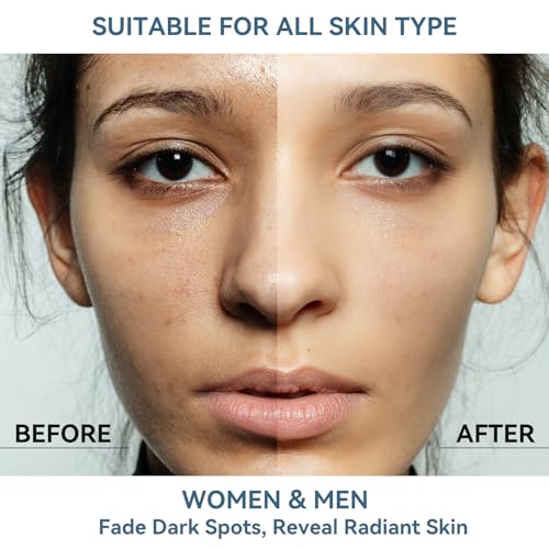 Dark Spot Remover for Face and Body, Dark Spot Corrector Serum, Melasma Treatment for face, Age Spot & Freckles Remover, Skin Care Serum for Uneven Skin Tone with 360° Roller Massage Ball, 0.67 fl. oz - Image 5