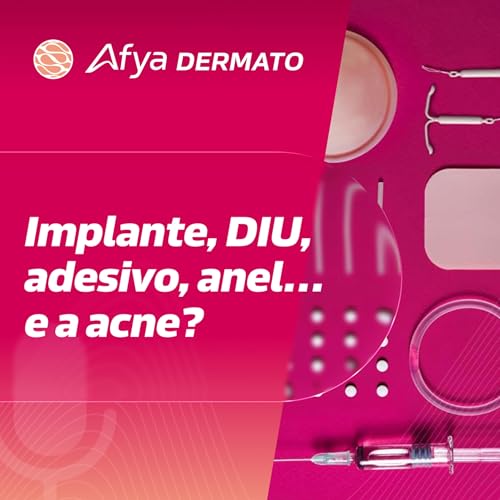 Outros contraceptivos hormonais: ajudam ou pioram a acne?