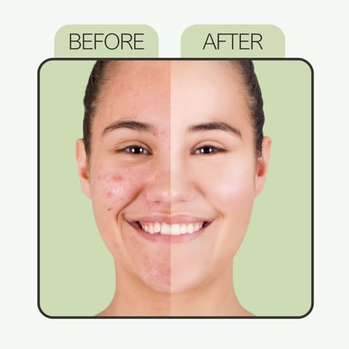 Image of Anti Acne Face Serum with 2% Salicylic acid, 2% Hyaluronic acid & 5% Niacinamide for Fights Acne, Reduces Pores, Controls Oil (Size-30ML)
