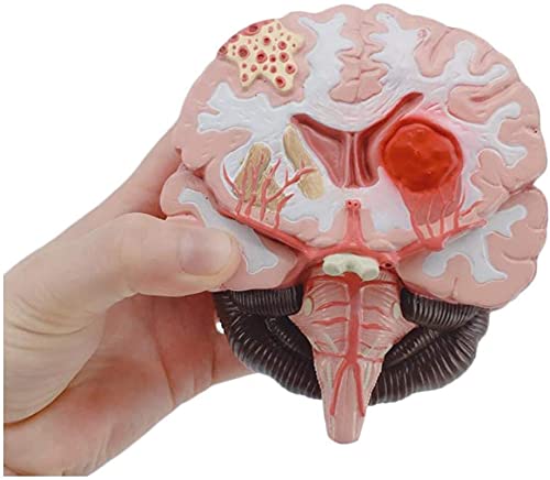 HAILIA Modelo de Cerebro anatómico Cerebro malformado Modelo de Estructura patológica Corteza Cerebral Materia Gris Tallo Cerebral Hemorragia Modelo de anatomía arteriovenosa