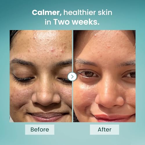 Image of The Solved Skin Barrier Repair Gel Moisturizer for Acne-Prone Skin | 1% Ceramide Complex Stops Irritation, Dryness & Redness | Lightweight, Non-Greasy, Won't Clog Pores | Fragrance-Free | 50ml