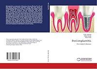 Peri-implantitis: Peri-implant diseases 6139915783 Book Cover