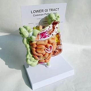 Human Colorectal Lesion Model, GI Tract Model, Human Body Anatomy Replica of Digestive System for Doctors Office Educational Tool