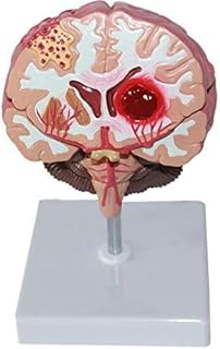Anatomical Model Brain, Human Brain Model, Human Diseased Brain Brainstem Pathology Demonstration Model, Disassembled Brainstem Pathology Demonstration Model for Medical Anatomical Teaching