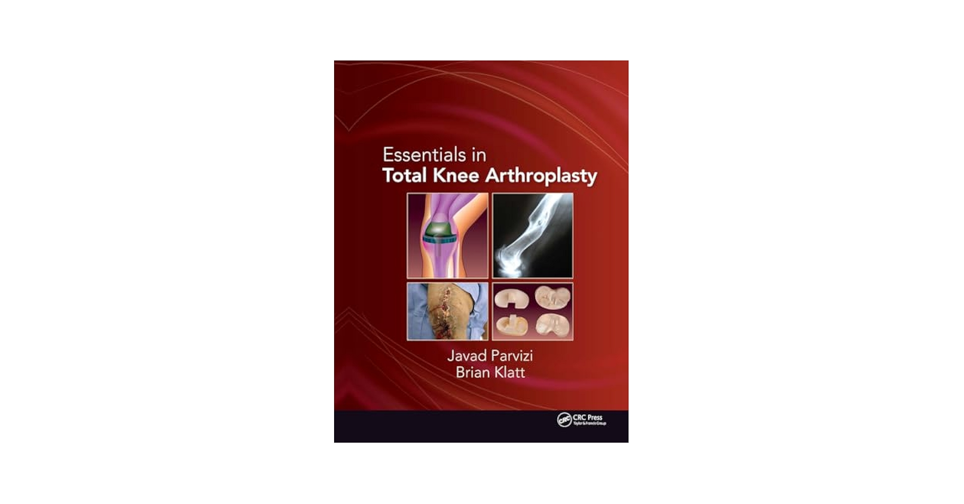Essentials in Total Knee Arthroplasty: 9781556428517