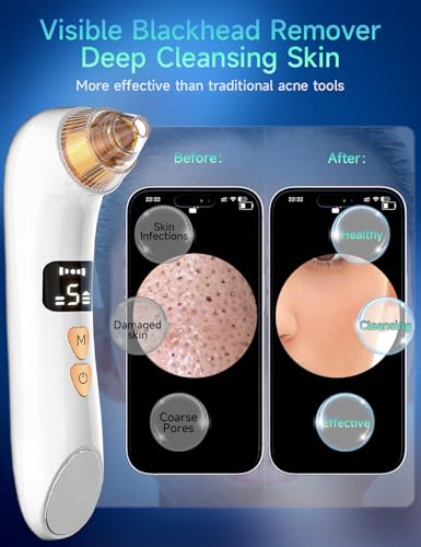 Image of Upgraded Visible Blackhead Remover Pore Vacuum,5 Suction Levels,6 Probes | Heating Facial Deep Cleansing,6MP HD Camera,25X Magnification Facial Pore Acne,Comedone Whitehead Extractor Tools Women Men